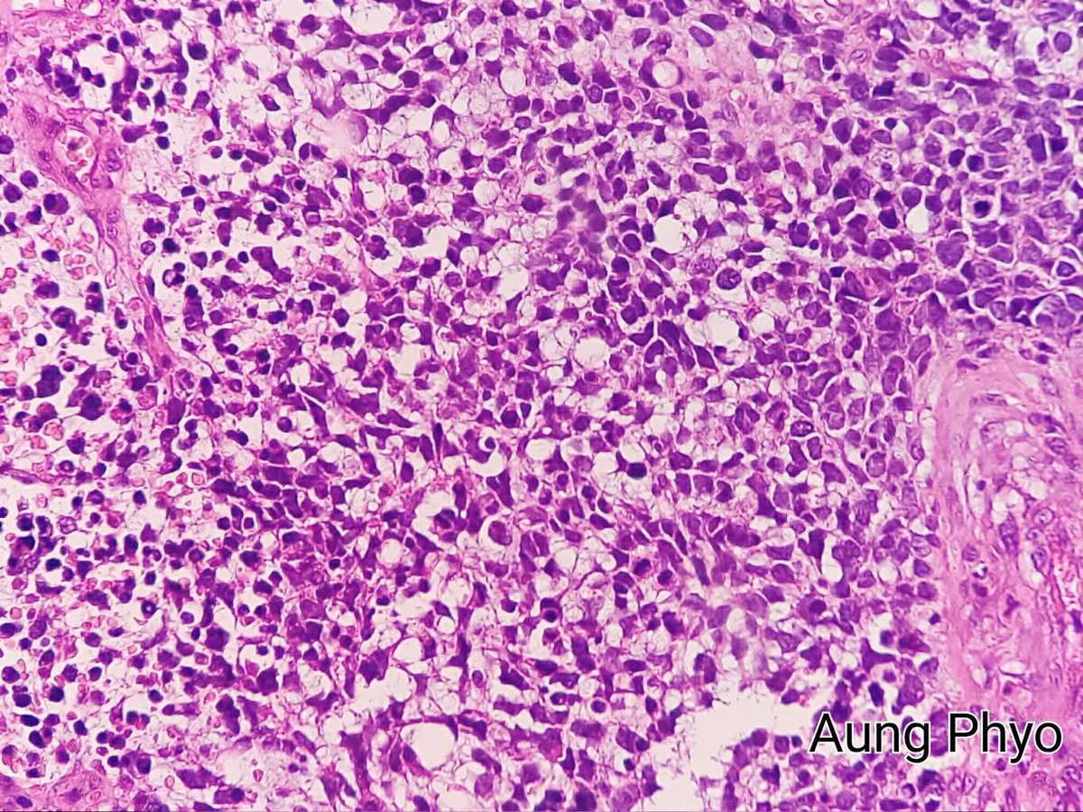 pathphyo's tweet photo. 17 years old girl with heavy vaginal bleeding. VE reveals ?cervical polyp.
A nice histology of tadpoles swimming in myxoid stroma together with small blue cells consistent with sarcoma botryoides (embryonal rhabdomyosarcoma).
#pathology #Sarcoma #ERMS https://t.co/Jfn1DF82E6