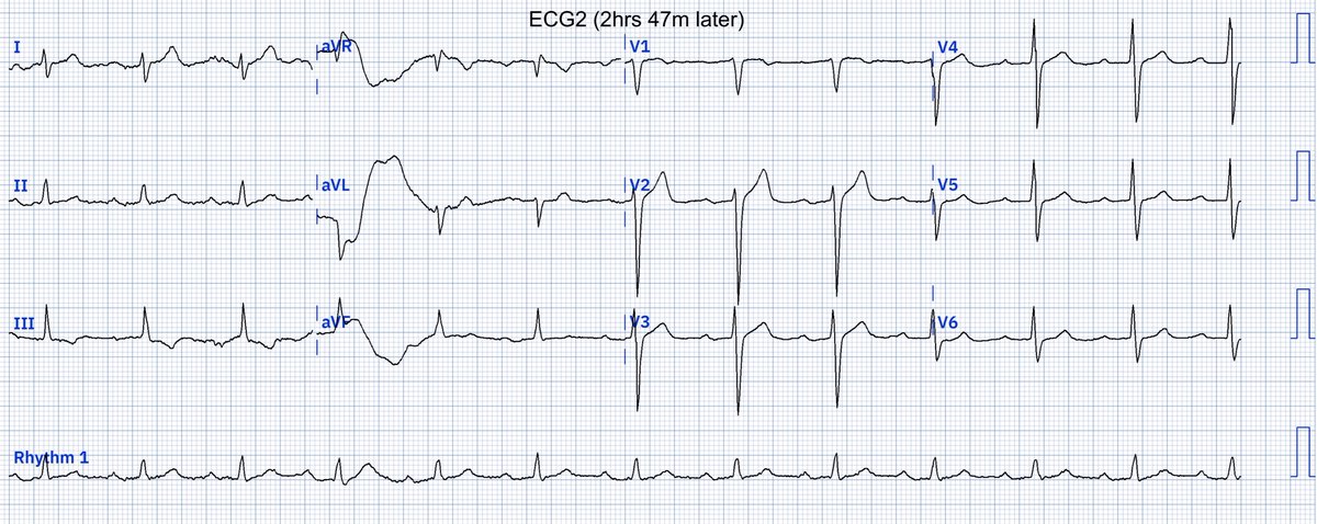 EcgOxford's tweet image. CP R/T Jaw w/o dynamic changes
Dx?
@akneton @yolyabreuh @UlhasDr @DidlakeDW @ecgrhythms @IhabFathiSulima @DrPharmDMDTh @Vadeboncoeur_Al @smithECGBlog @EM_RESUS @estudiomedicina @OrlandoRPN @fxgodzeuss #EPeeps #FOAMcc @ResusMed @TrRja @NaokiThukishima @ecgandrhythmRoe