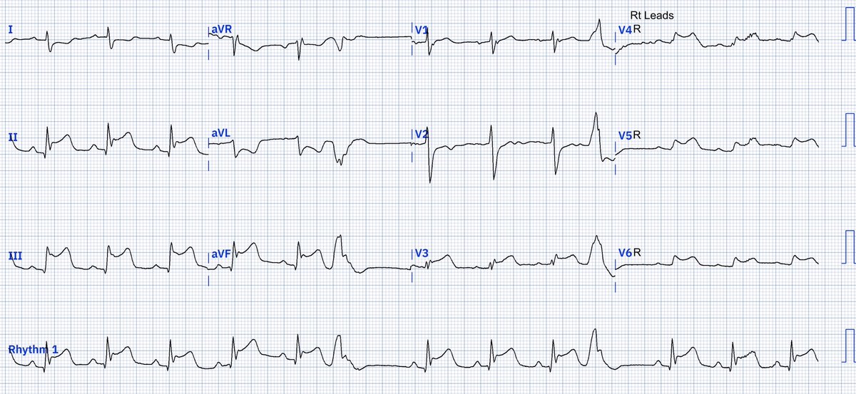 EcgOxford's tweet image. CP
Dx?
@akneton @yolyabreuh @UlhasDr @DidlakeDW @ecgrhythms @IhabFathiSulima @DrPharmDMDTh
@Vadeboncoeur_Al @smithECGBlog @EM_RESUS
@estudiomedicina @OrlandoRPN @fxgodzeuss #EPeeps #FOAMcc @ResusMed @TrRja @NaokiThukishima @ecgandrhythmRoe