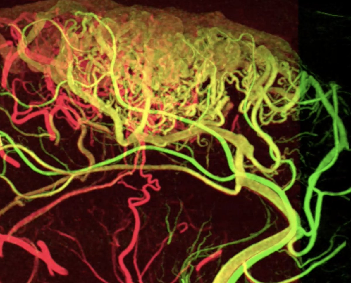 neuroangio1's tweet image. 🍌🍌🍌See you later at Noon NY | 6 PM CET #BANANAz online On the roster: Fabian Arnberg, Dodi Boccardi, Rene Chapot, Vi Tran, Maksim Shapiro + more. Zoom link: neuroangio.org/bananaz Bring a case, join the convo!