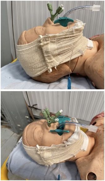 🔑 In major trauma, the priority is a patent airway + adequate oxygenation.
Suspected unstable cervical spine injuries are rare, and airway takes precedence.
Read more: bjaed.org/article/S2058-…
#Prehospital #AirwayManagement