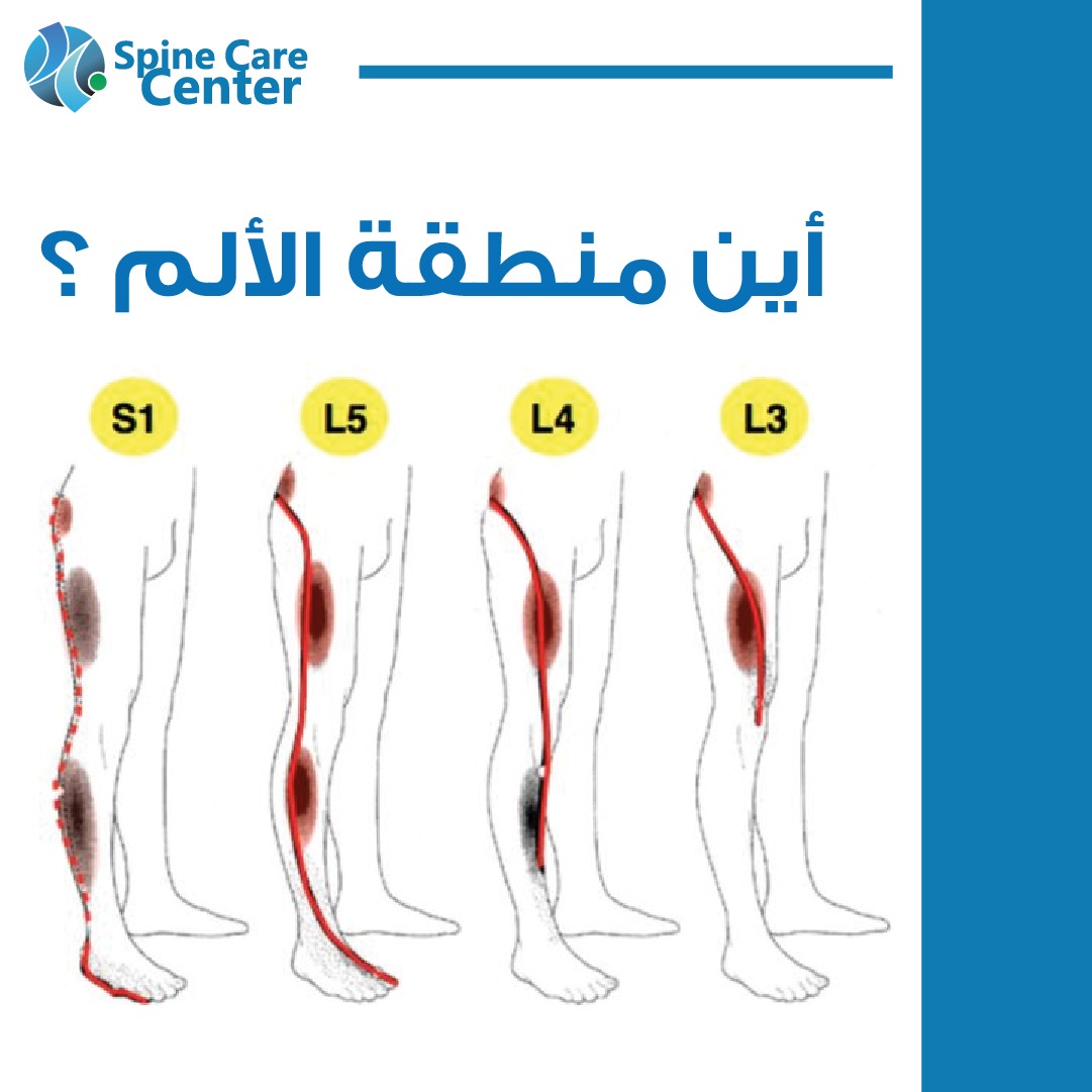 💥 خريطة آلام الظهر والساق بين الانزلاق الغضروفي والأسباب الأخرى
متابعينا الأعزاء،
 هذا شرح مبسط لتوزيع الألم الناتج عن الانزلاق الغضروفي في الفقرات القطنية من L1 إلى L5، وكيف يضغط الغضروف على الأعصاب فيظهر الألم في أماكن مختلفة من الجسم.
 لكن مهم نعرف إن نفس المناطق ممكن تتألم