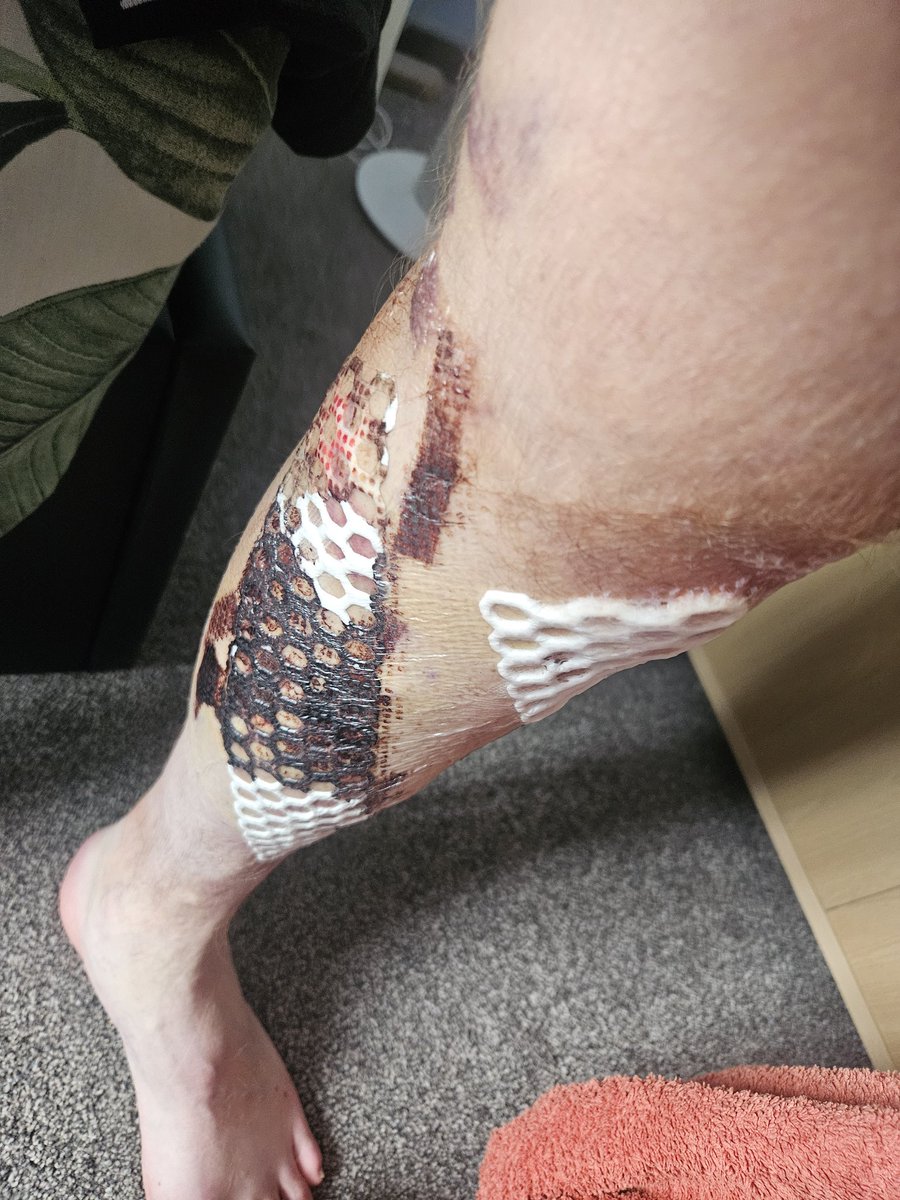 Out here looking like I've done 12 rounds with a boiling kettle, AND LOST

Not a bad time to be signed off work from the day after new fifa though 😉