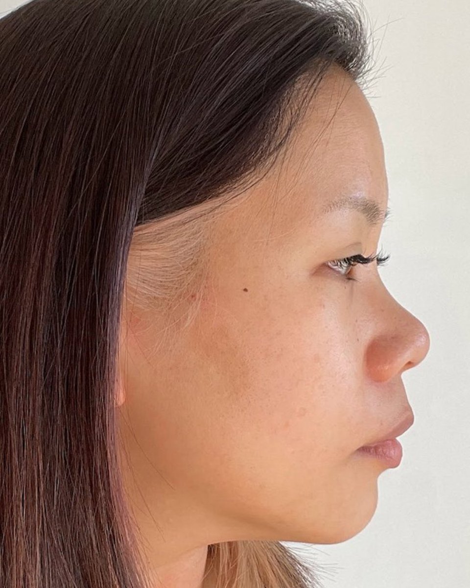 🗣️ Name: Olivia 
❤️ Skin concern: Acne 
⏰ Treatment length: 5 months