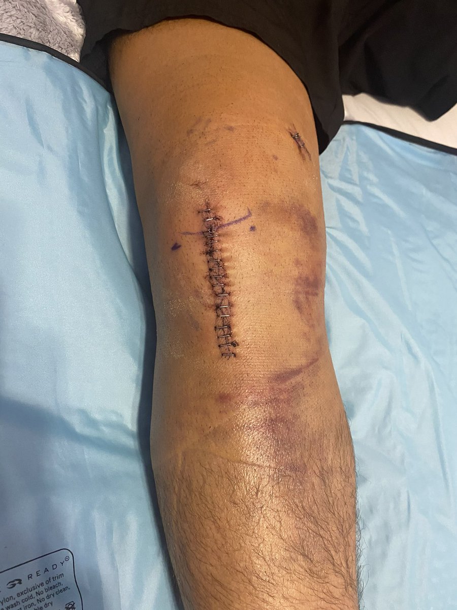 JordanCoblin's tweet image. Never give up on your dreams

4 years ago, I tore my ACL
A year later, I tore my meniscus — same knee
High school, I was unranked 
0 offers/0 scholarships

I wasn’t the biggest, fastest, or strongest growing up. 
Just a kid from Boca Raton, Florida
Chasing something no one else…