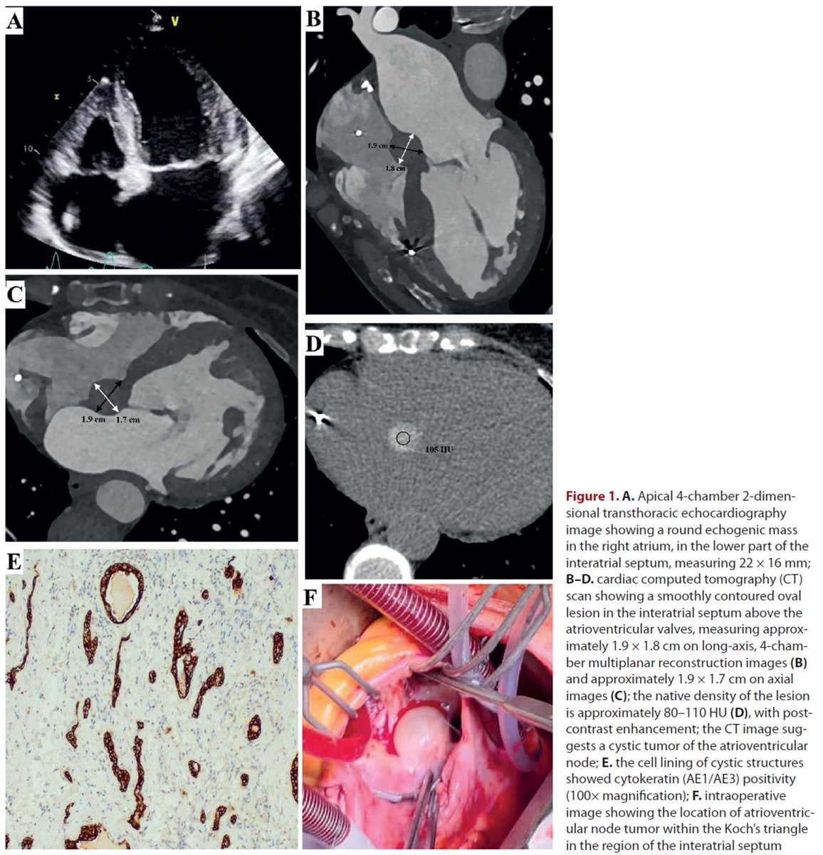 heart_polish's tweet photo. Editors' Insights: An #incidental finding of an atrioventricular node #tumor during standard hospitalization years after pacemaker implantation.
https://t.co/m75ALyflx8
#PolishHeartJournal #CardioTwitter #HeartNews #Cardiology @PWr_Wroclaw https://t.co/CokDT2RCAM