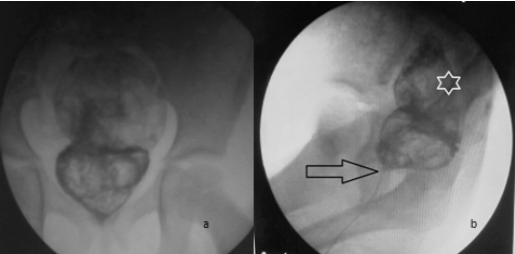 👶 A 7-year-old girl presented with passage of stool &amp; gas through the vaginal opening.

📸 X-ray, US &amp; MRI confirmed congenital rectovestibular fistula — a rare anorectal malformation.

👉 Lesson: Radiology is key for diagnosis &amp; guiding surgery.

🔗 Read more here: