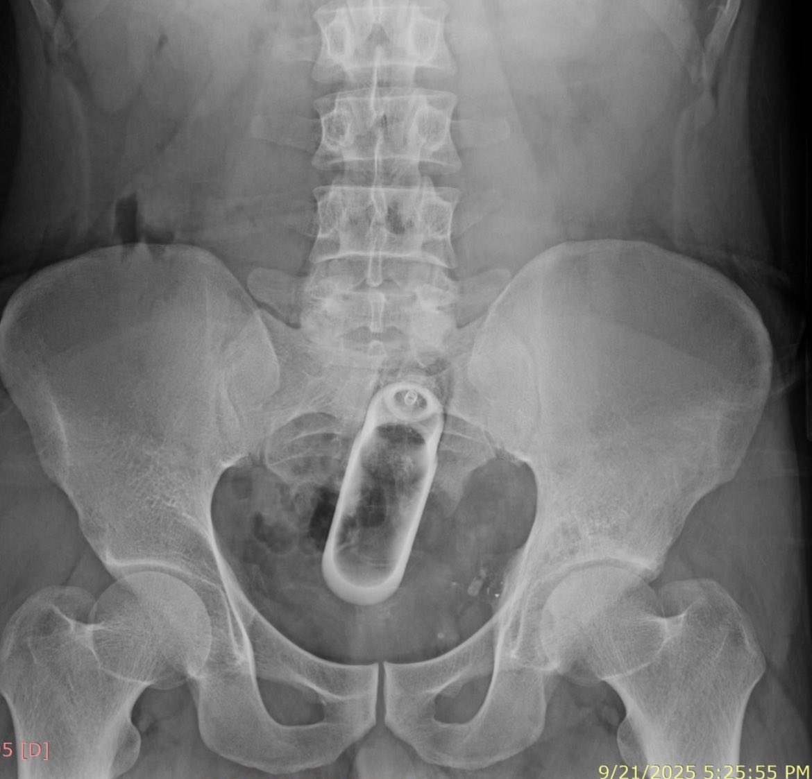 joeygallinal's tweet image. I don’t think people understand: there’s a point of no return 
#radiology
#boofing