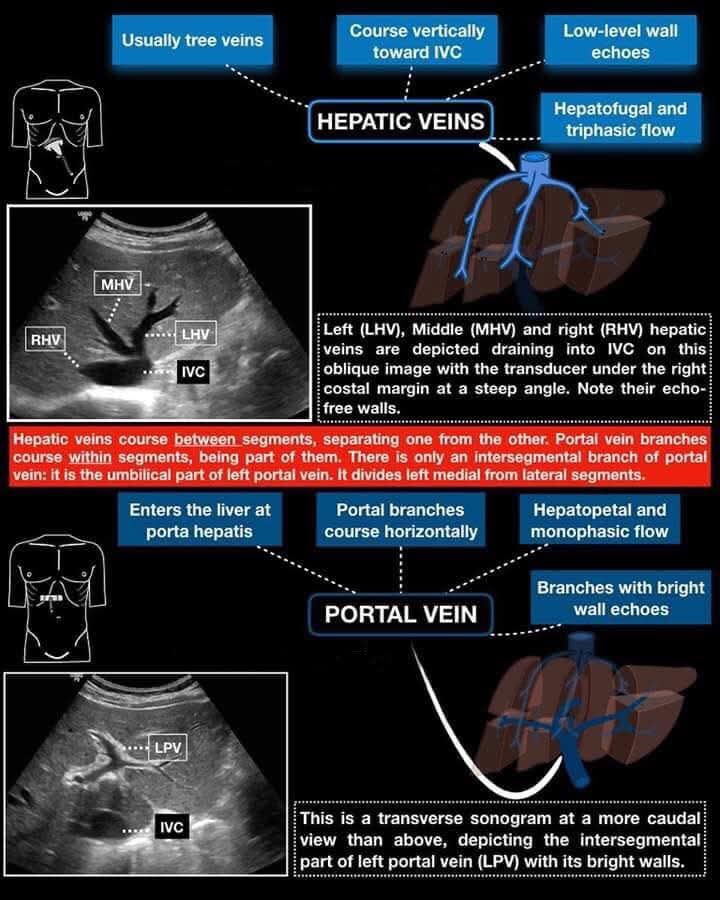 Hepatic veins: run vertically toward the IVC, have echo-free walls, separate liver segments, and show hepatofugal triphasic flow.
Portal vein: enters at the porta hepatis, runs horizontally within liver segments, has bright echogenic walls, and shows hepatopetal monophasic flow.