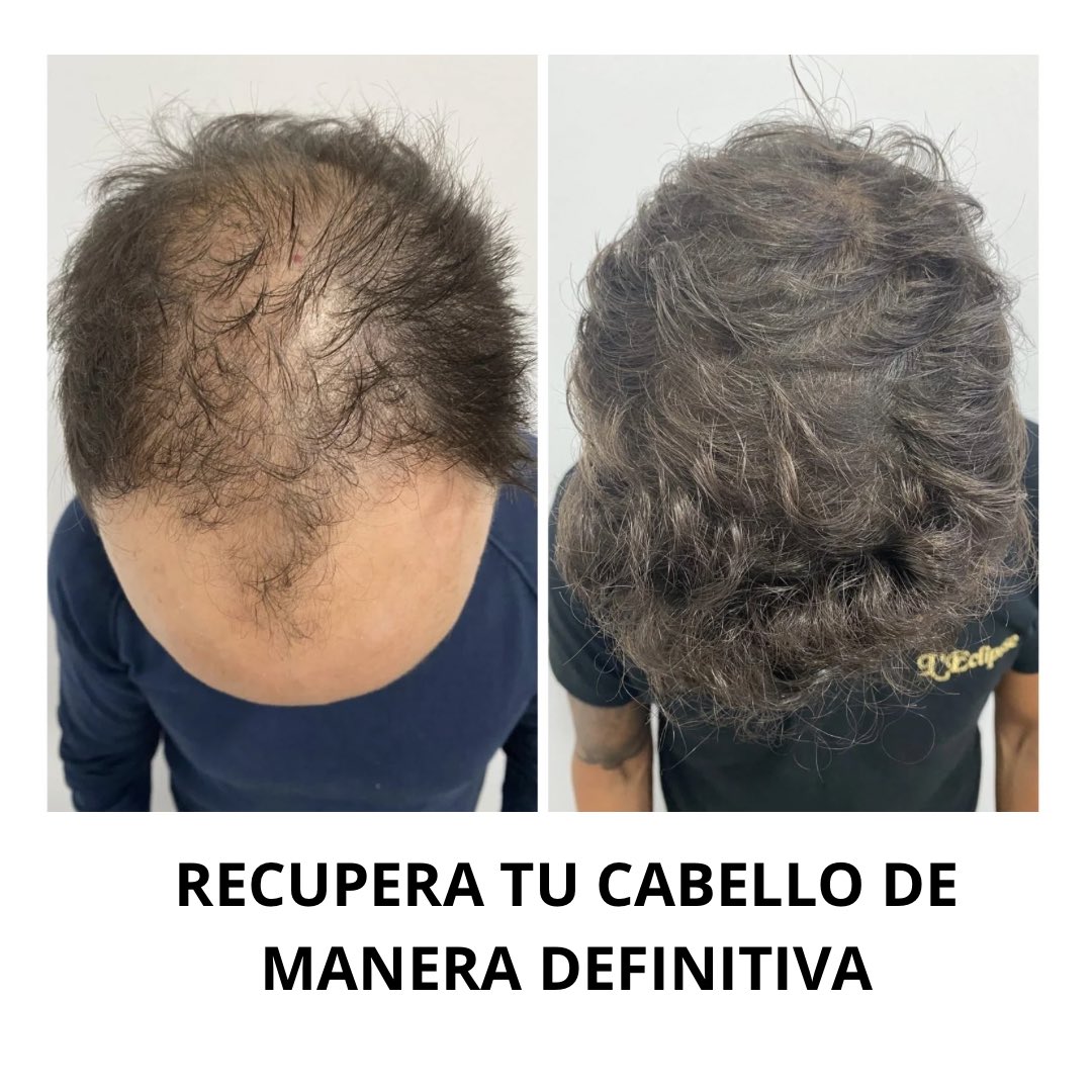 cmepilo's tweet photo. En PILO contamos con los mejores especialistas en tratamientos capilares, la tecnología más avanzada y un equipo de excelencia. 🩺✨ Con un 99% de efectividad, cuidamos tu imagen y tu confianza. 💎🌱🙌

- Consulta de valoración gratuita. 

🔍 #tratamientocapilar https://t.co/PtJHjGCvKa