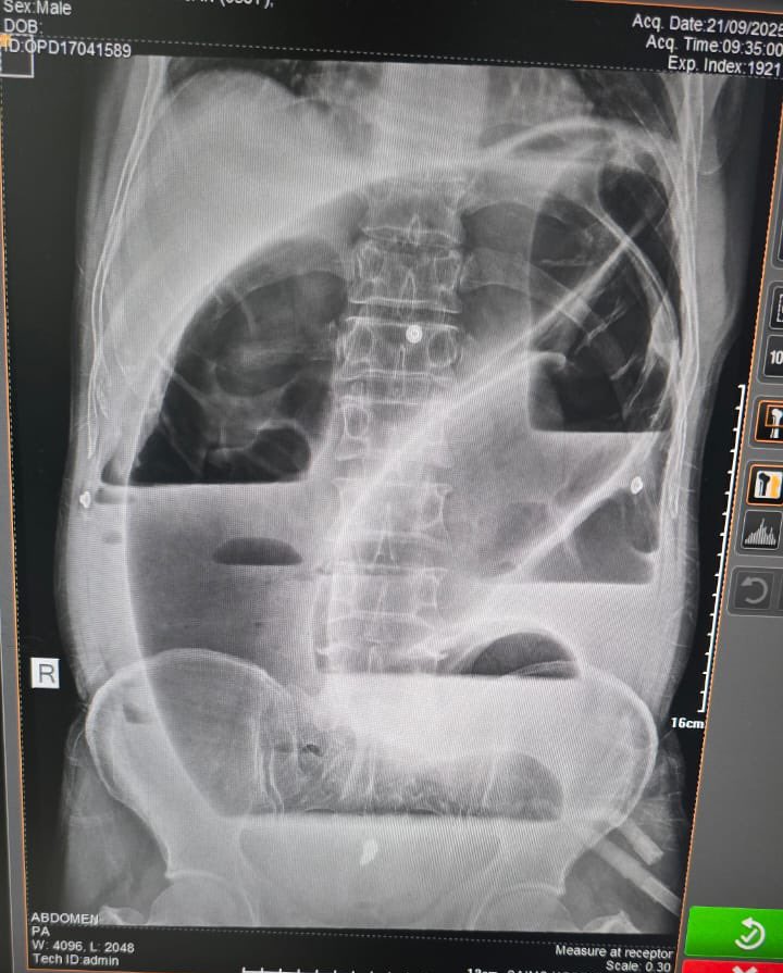 Sigmoid volvulus 
How to manage ?
👉🏻Take care of Airways
👉🏻IV fluids

✅ No peritonitis / no perforation 
→ Endoscopic decompression followed by Elective sigmoidectomy

⚠️ Unstable / peritonitis / gangrene / perforation
→ Emergency resection (primary anastomosis or Hartmann’s)