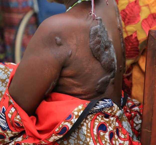 ASOU_Official's tweet image. Screening of plastic surgery cases  as part of #WestNileSurgicalCamp2025.  A large number of patients from the community have been assessed, highlighting the critical need for surgical interventions in the region. This initiative aims to restore health, improve quality of life,…