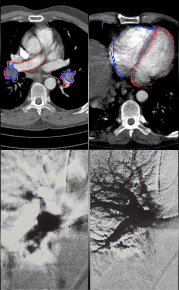 Massive PE ⏩️ pulmonary artery thrombectomy 🫁