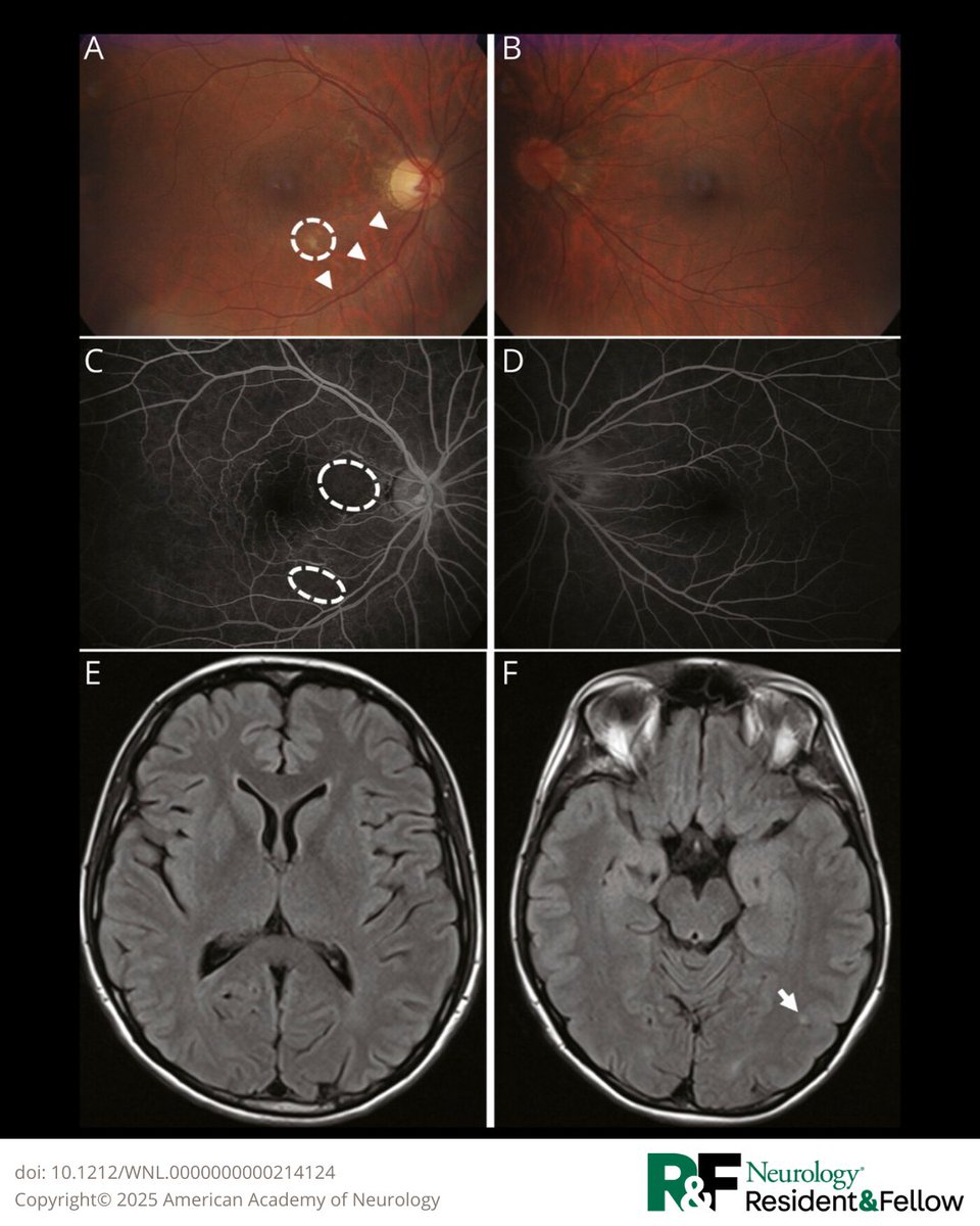Pearls &amp; Oy-sters: Adult-Onset Coats Plus: A Case of Leukoencephalopathy With Calcifications, a Tumefactive Brain Lesion, and a Presumed Autoimmune Disease
hubs.la/Q03KbtX10

#NeurologyRF