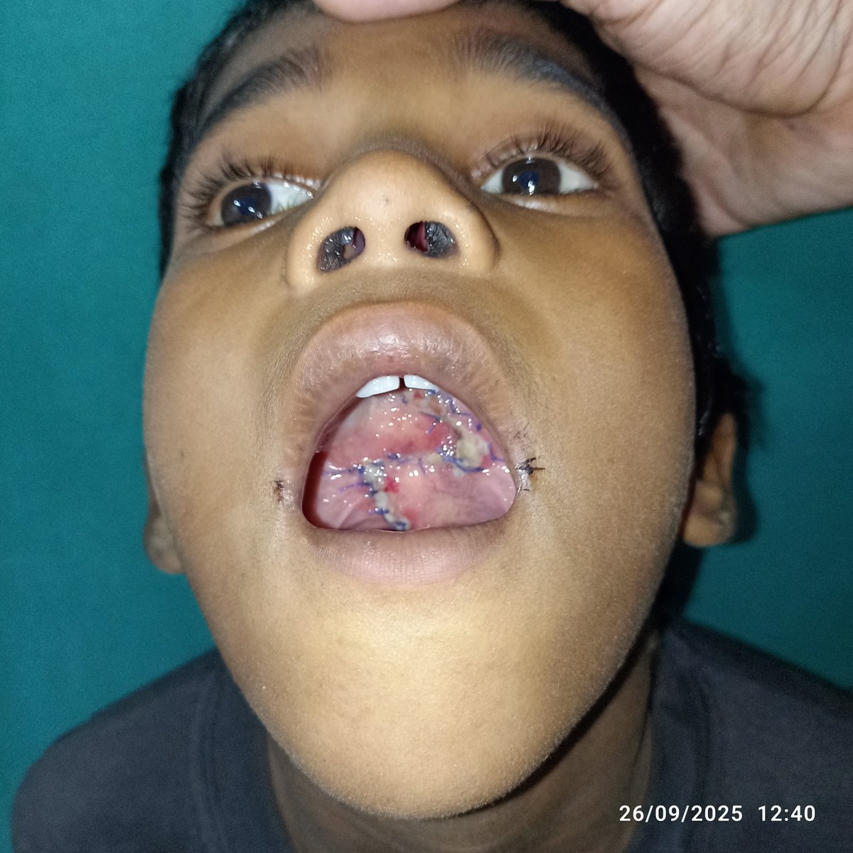 DhsBanda's tweet photo. Cleft lip &amp; Plate Camp held in District Hospital under SNSP Abhiyan https://t.co/ZYMRq5cfGi