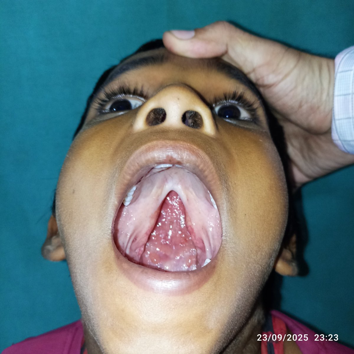 DhsBanda's tweet photo. Cleft lip &amp; Plate Camp held in District Hospital under SNSP Abhiyan https://t.co/ZYMRq5cfGi