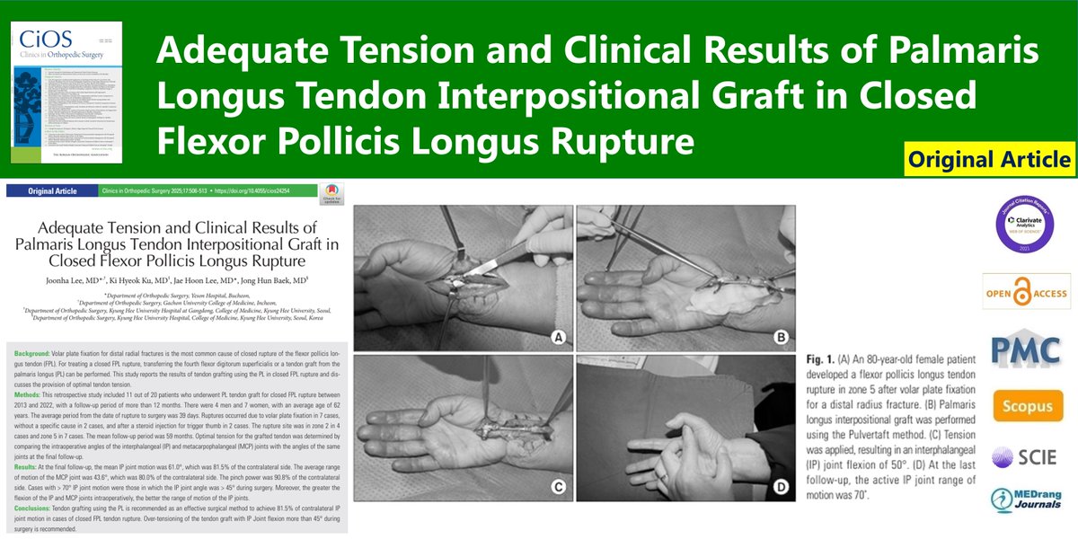CiOSjournal's tweet image. Adequate Tension and Clinical Results of Palmaris Longus Tendon Interpositional Graft in Closed Flexor Pollicis Longus Rupture
🌷doi.org/10.4055/cios24…
Clin Orthop Surg. 2025 Jun;17(3) Joonha Lee
#Tendon_injuries #Thumb #Tendon_transfer #Wrist_fractures #Tendinopathy