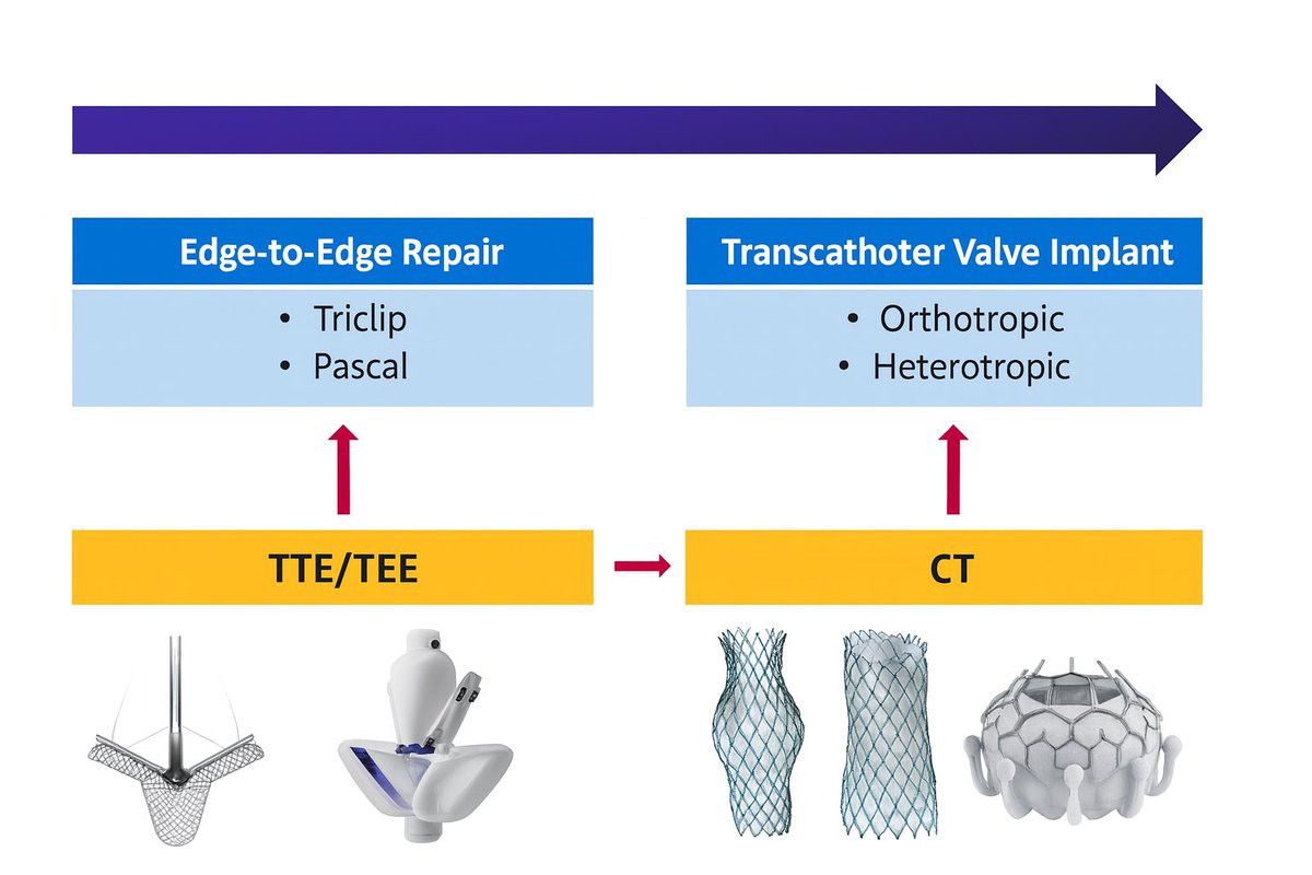Bgheyath's tweet image. 1/3 Intro to  #Tricuspid therapies (a thread📌)
🔹 TTE/TEE → key for anatomy, mechanism &amp;amp; feasibility of edge-to-edge repair (TriClip, Pascal).
🔹 CT → essential for valve implant planning (orthotopic &amp;amp; heterotopic).

Credit: Drs. M. Alasnag &amp;amp; A. Merdad
#PCRGulfValves