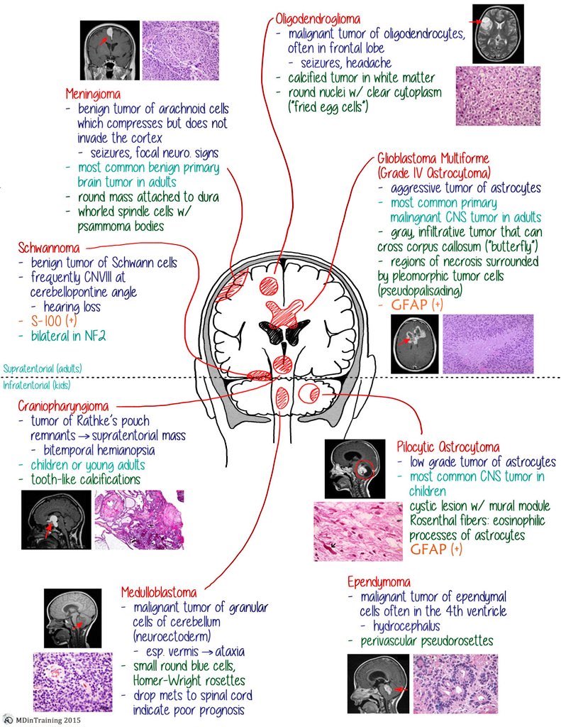 TheKoshurDoc's tweet image. BRAIN TUMORS - MOST COMMONS

1) Most common tumor of the brain:
Metastasis secondary to Lungs &amp;gt; Breast

2) Most common primary CNS tumor:
Glioma &amp;gt; Meningioma

(1/3)

#FOAMed #MedEd #MedTwitter #USMLE
#NEETPG @IhabFathiSulima #PathoPearls