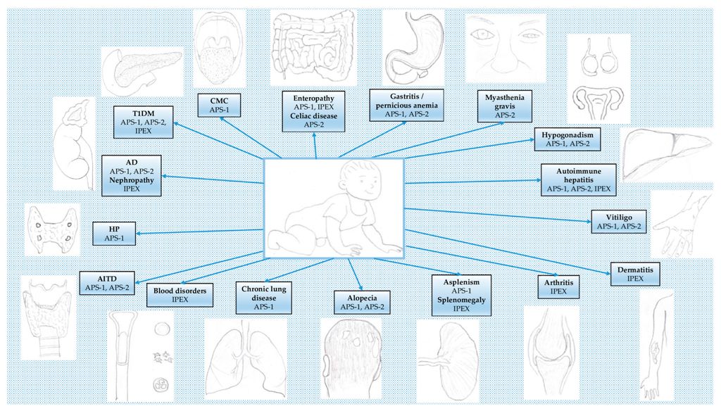 Children_MDPI's tweet photo. #mdpiopenaccess #mdpichildren Call for readings for our Highly Viewed Paper in 2023👏
Title: #Autoimmune #Polyendocrine Syndromes in the #Pediatric Age
by Dr. Roberto Paparella et al.
View full-text on: https://t.co/f8ZTlVe91q
@MediPharma_MDPI https://t.co/4WN3TNqA3u