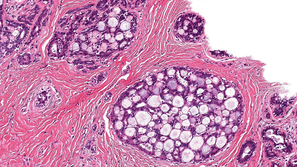 RazaHoda's tweet image. Let’s review cribriform morphology 🍪 in breast pathology this week!
Case of Collagenous Spherulosis 🔬
Bland myoepithelial cells baking up collagen balls 🧑🍳✨—looks like adenoid cystic carcinoma or ADH, but it’s a sweet mimic. 😇
#PathX #PathTwitter #breastpath