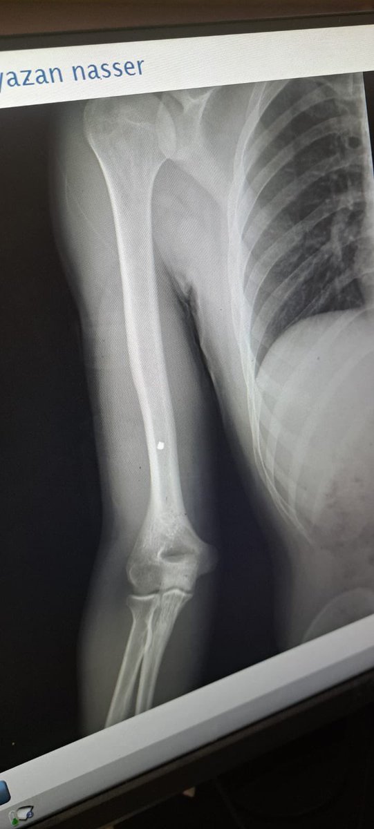 YazanNasser2002's tweet image. *I miraculously survived a reconnaissance missile, but...&quot;
I was hit by shrapnel that lodged between the bone and nerve in my arm, and it remains in my body to this day due to the limited resources in Gaza.
The doctors told me I needed urgent surgery abroad, but there was no…