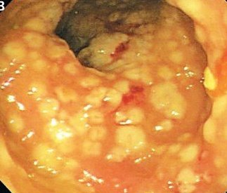 IhabFathiSulima's tweet image. Elderly Patient with loose motions.
#Endoscopy showed #Fried_Egg_Appearance.
What is the diagnosis?
What is the treatment?
#med #MedTwitter