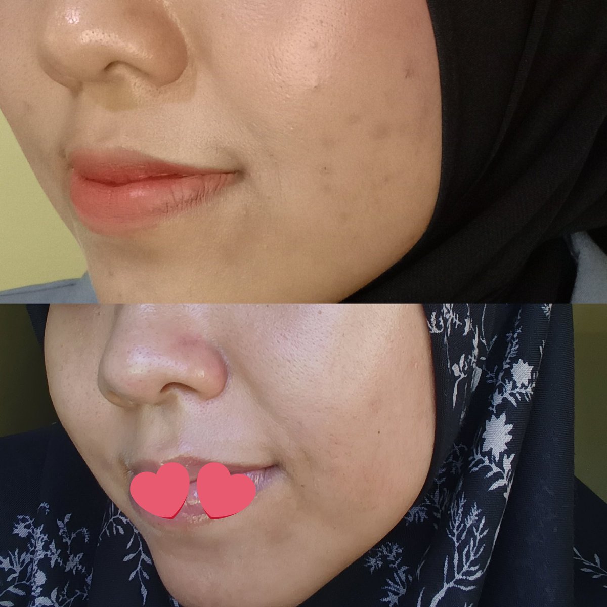 refitaevriyanii's tweet image. Part paling rewel dari mengurus jerawat adalah bekasnya! Bandel banget diwajah

Mau kasih info hero skincare untuk hilangin bekas jerawat ➡️➡️ Dark Spot Correcting Glow Serum dari AXIS-Y 💚💚
#axisyglowserum #axisyindonesia