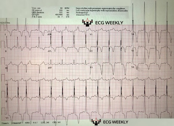 52 yo with PMHx of hypertension presents after a syncopal episode at home. He felt lightheaded while standing briefly lost consciousness without seizure activity or trauma. No prior syncope, stimulant use, and no family history of sudden death is known.   rebrand.ly/pdhwbjk