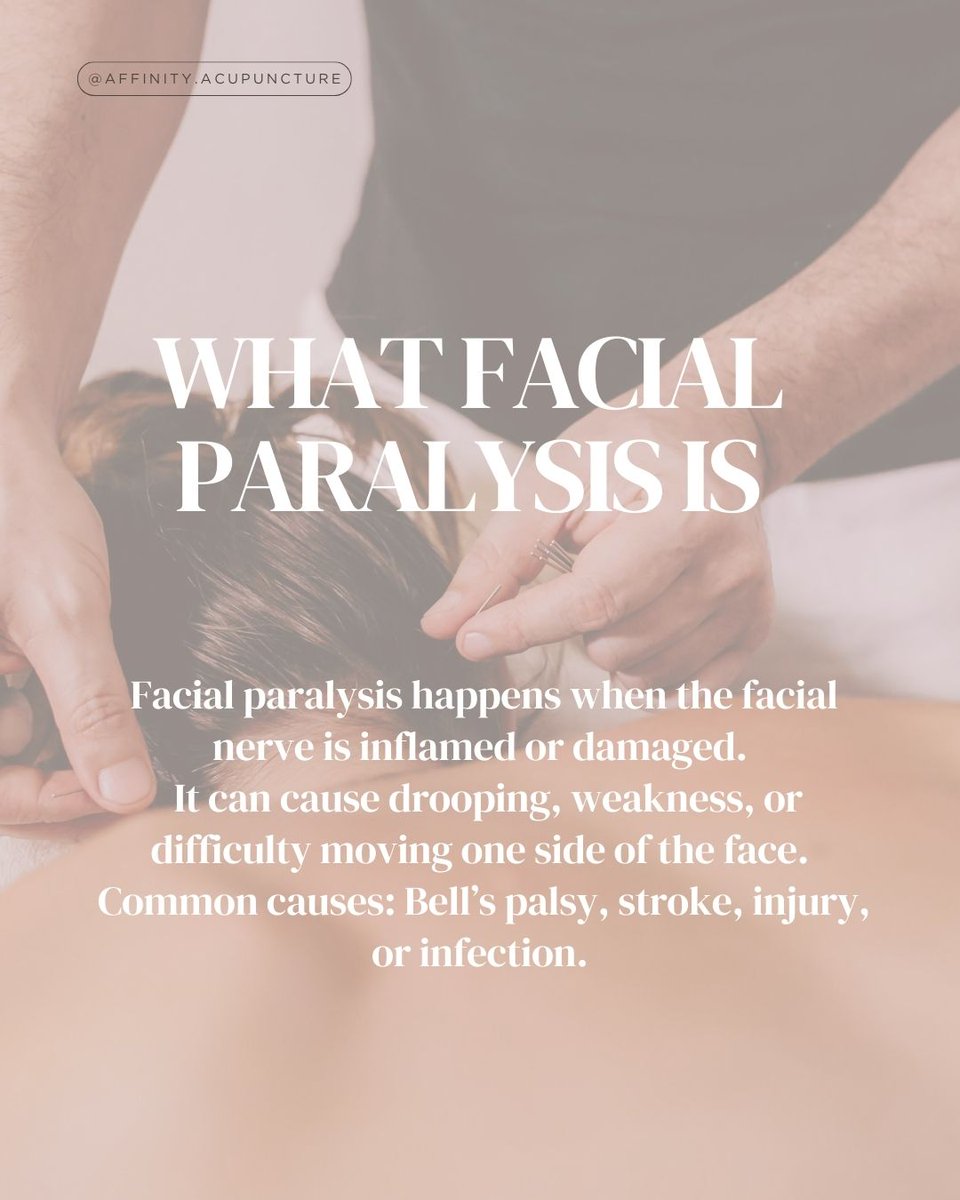 AffinityAcupunc's tweet image. Call us today at 615-939-2787 or visit affinityacupuncture.com to schedule your consultation
#acupuncture #facialparalysis #bellspalsy #acupuncturenashville #nerverecovery #naturalhealing #holistichealing #brentwoodtn #affinityacupuncture #neurologicalhealth #acupunctureworks