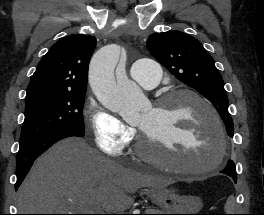 ctisus's tweet photo. Type A Dissection https://t.co/CPe83tANM3