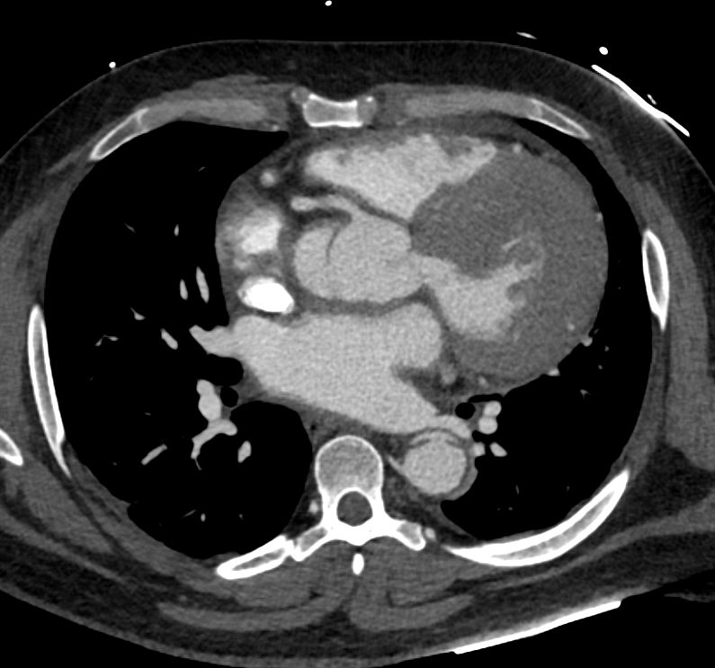 ctisus's tweet photo. Type A Dissection https://t.co/CPe83tANM3