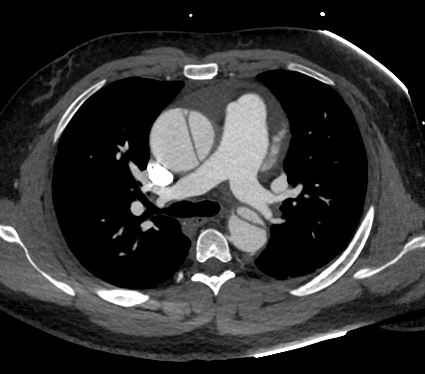 ctisus's tweet photo. Type A Dissection https://t.co/CPe83tANM3