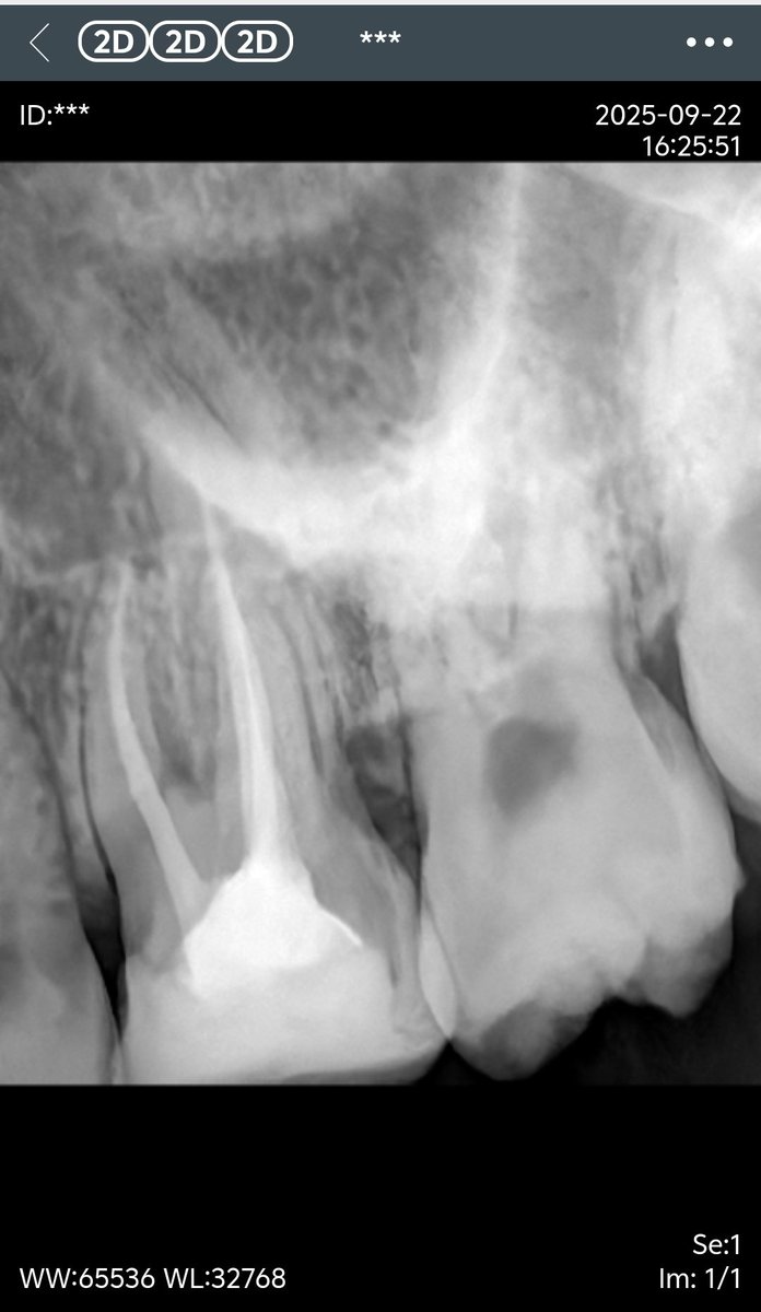 本人第一次一个人在距离家2000km以外的地方独立完成看牙医做根管！（其实有g的陪伴啦小机功不可没👍）（手动添加懒羊羊bgm）