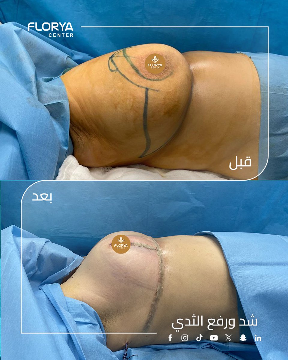 FloryaHospital's tweet photo. اكتشفي جمالك بتناسق مثالي مع نتائج طبيعية لرفع وتكبير الثدي. شاهدي الفرق الواضح قبل وبعد العملية واحصلي على إطلالة تزيدك ثقة وجاذبية.
#رفع_الثدي #تكبير_الثدي #تجميل_الثدي #جراحة_تجميلية #نتائج_مبهرة #ثقة_بنفسك https://t.co/DDYc2hLEIU