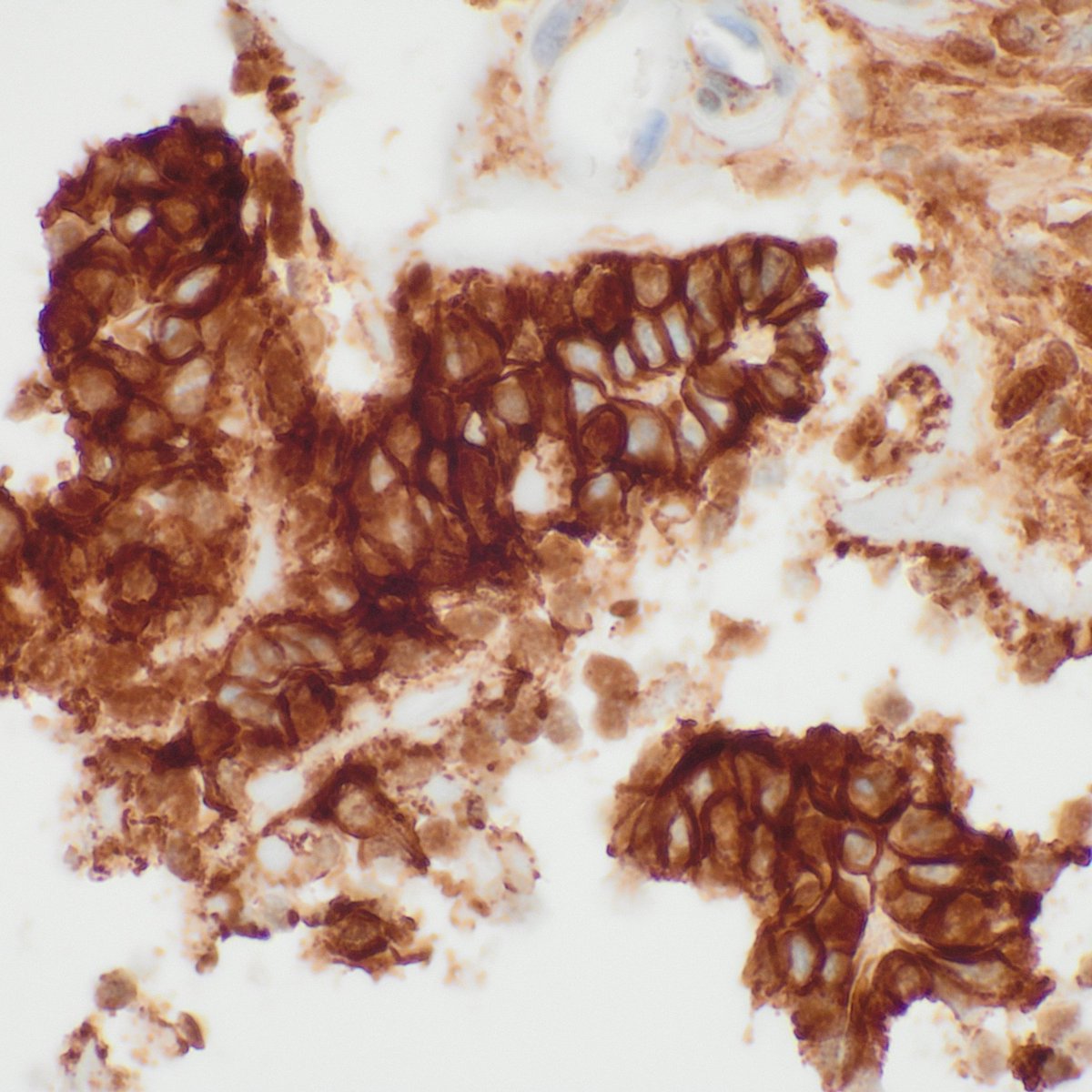 JoanWolfBig1's tweet photo. Parotid gland FNA 🧫: Papanicolaou &amp; Diff-Quik smears + cell block with β-catenin IHC 🔬 → CTNNB1 p.I35T 🧬. Basaloid tumor consistent with basal cell adenoma.

#Pathology #Cytology #SalivaryGland #Parotid #BasalCellAdenoma #MolecularPathology #FNA https://t.co/h5NrArMKs1