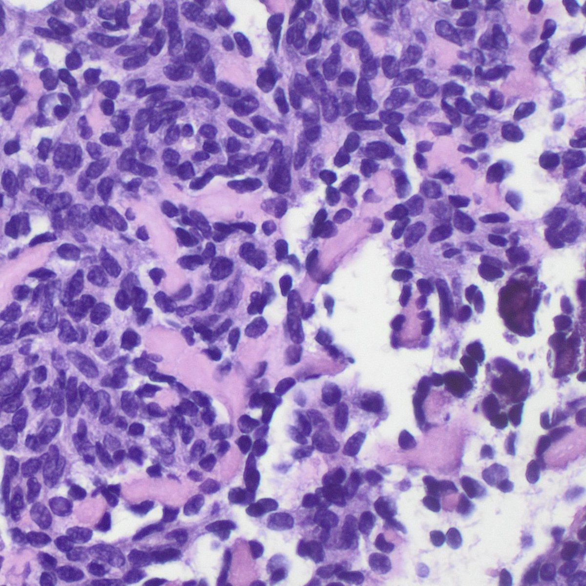 JoanWolfBig1's tweet photo. Parotid gland FNA 🧫: Papanicolaou &amp; Diff-Quik smears + cell block with β-catenin IHC 🔬 → CTNNB1 p.I35T 🧬. Basaloid tumor consistent with basal cell adenoma.

#Pathology #Cytology #SalivaryGland #Parotid #BasalCellAdenoma #MolecularPathology #FNA https://t.co/h5NrArMKs1