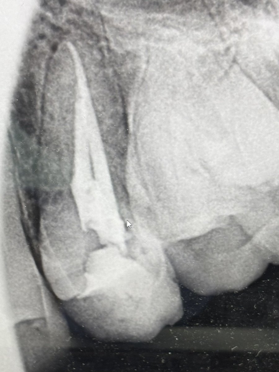 ii9b25's tweet photo. RCT for tooth number 25 https://t.co/6ycUQOr14t