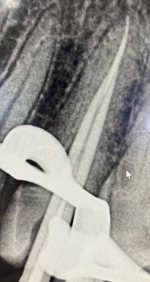 ii9b25's tweet photo. RCT for tooth number 25 https://t.co/6ycUQOr14t
