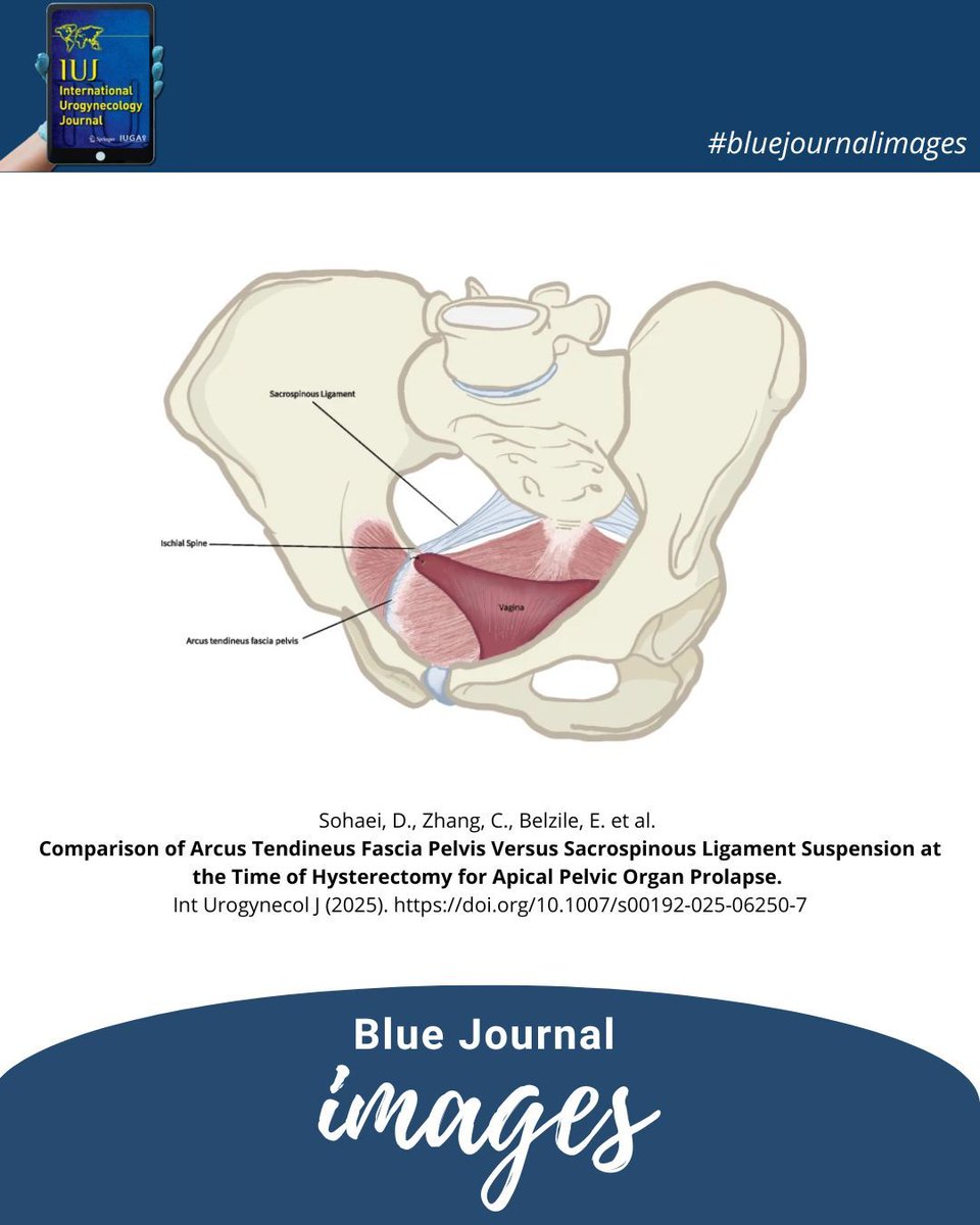 #bluejournalimages: This original article compares two native tissue suspension techniques for correcting apical pelvic organ prolapse.

📌 link.springer.com/article/10.100… 

@clinmedjournals <a href="/iugaoffice/">International Urogynecological Association (IUGA)</a> 

#iuj_bluejournal #urogynecology #pelvicorganprolapse #nativetissuerepair