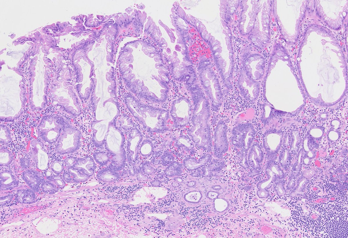 my.uscap.org/app/program/8Z… During this hands-on case-based course, we'll review the newest diagnostic &amp; classification updates of tubular GI neoplasms, with changes coming up in the new WHO blue book to be published in early 2026, with some of its actual editors &amp; authors!
#pathX