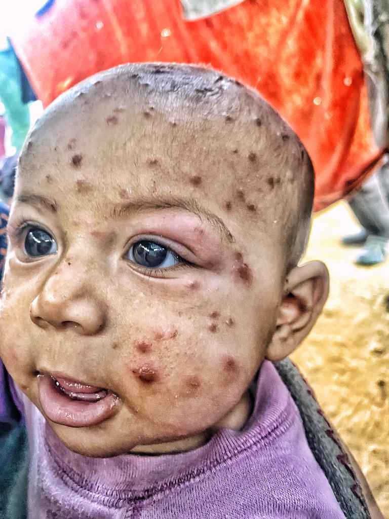 Our hearts ached for Tasneem's unstoppable tears from the intensity of her pain. Swellings and swellings above her eyes and painful blisters that spread quickly. The weather and the heat of the tent increased her suffering. She could not sleep from the intensity of the itching