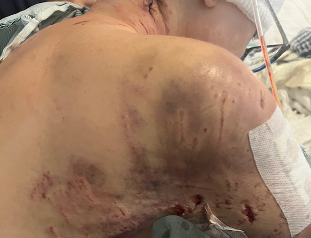 ShernMinKHOU's tweet photo. An incredibly brave mother of 2 survives a vicious attack by 4 pit bulls - on her gated property. What happened to her, the animals & their owner? She graciously shares her story. #KHOU11 at 6. @memorialhermann #Lifeflight @SHERIFF_WCSO https://t.co/HkmpAhRthH