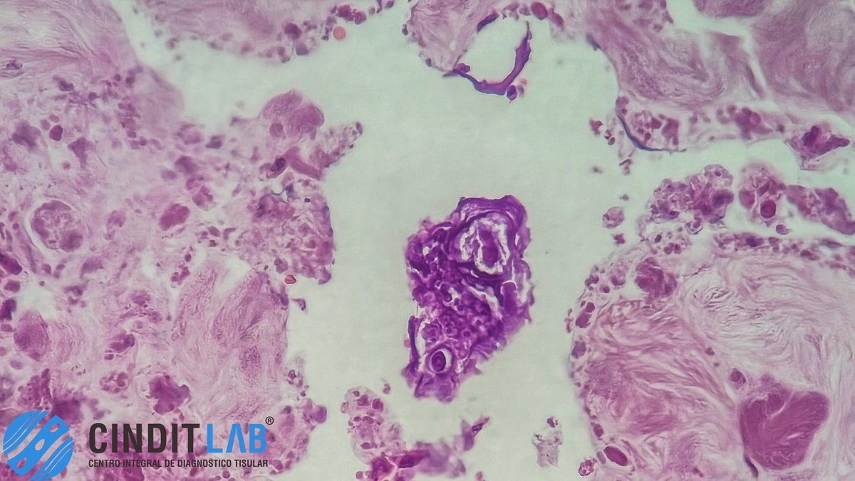 md_castaneda23's tweet photo. ¿Qué es la Salpingitis Parasitaria?
La salpingitis parasitaria es la inflamación de las trompas de Falopio (trompas uterinas) causada específicamente por una infección parasitaria. Es una forma poco común de enfermedad inflamatoria pélvica (EIP)
#cinditlab https://t.co/cVWE7fiWCi