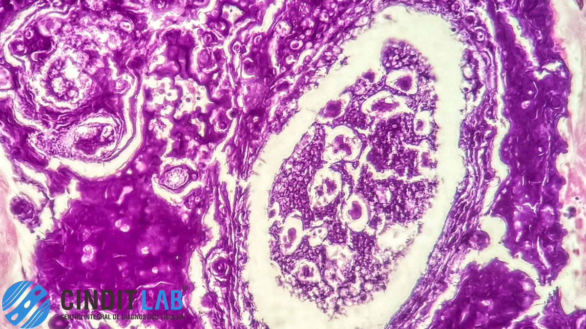 md_castaneda23's tweet photo. ¿Qué es la Salpingitis Parasitaria?
La salpingitis parasitaria es la inflamación de las trompas de Falopio (trompas uterinas) causada específicamente por una infección parasitaria. Es una forma poco común de enfermedad inflamatoria pélvica (EIP)
#cinditlab https://t.co/cVWE7fiWCi