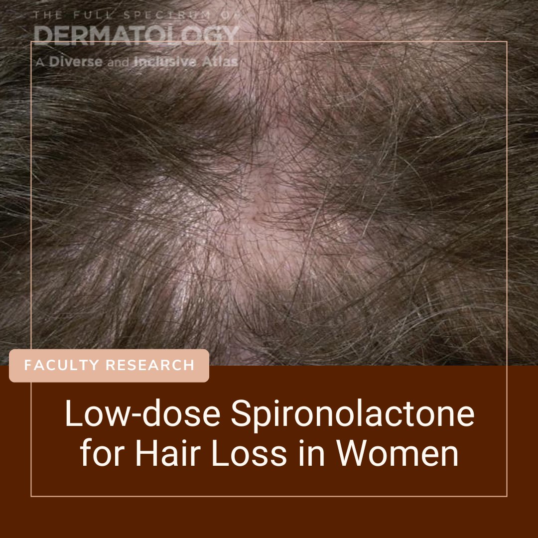 @skinofcolorderm faculty are involved with studies that have implications on clinical practice. View Dr. Maryanne Makredes Senna's @jddonline article on low-dose spironolactone for hair loss in women:

👉ow.ly/nuFq50X0iBm

#HairLossTreatment #Spironolactone #AlopeciaCare