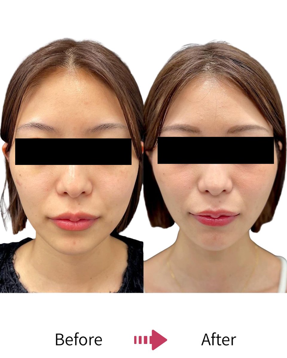 LumiereYM's tweet photo. 【お肌の悩み、あきらめていませんか？】

「最近、くすみが気になる」「毛穴が目立ってきた…」そんな時は、フェイシャルエステでプロのケアを

Lumiereでは、一人ひとりの肌悩みに合わせたオーダーメイドの施術で、うるツヤ肌へと導きます

自分へのご褒美に、ぜひ一度お試しください#エステ https://t.co/mtGsKaogkh