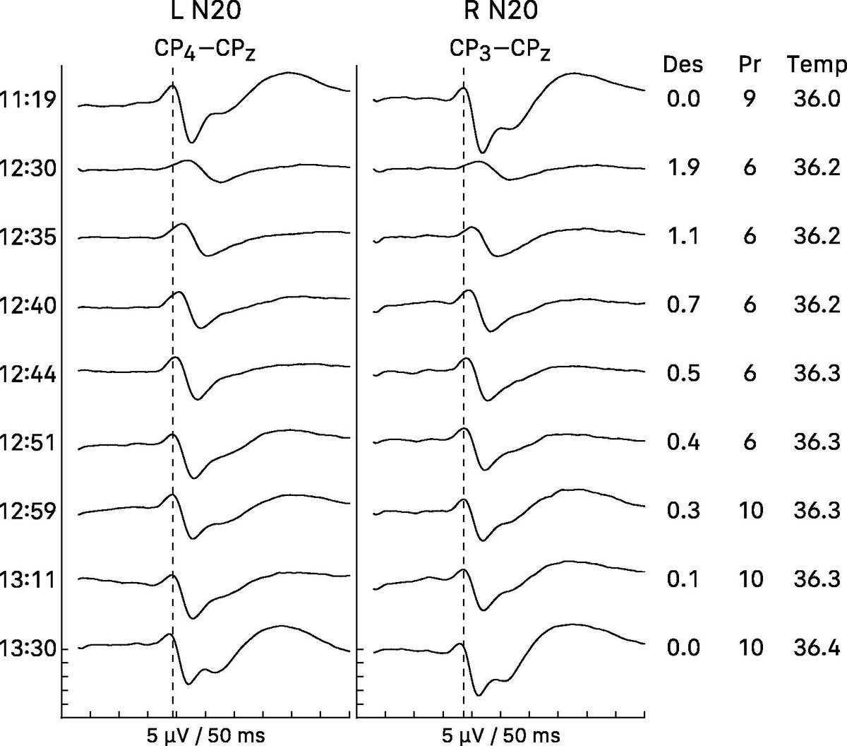 [Intraoperative somatosensory evoked potentials (SEPs)] MacDonald et al.: "This article reviews and forms recommendations for intraoperative SEPs. 
It endorses SEP optimization to enhance surgical feedback speed and accuracy."

doi.org/10.1016/j.clin…