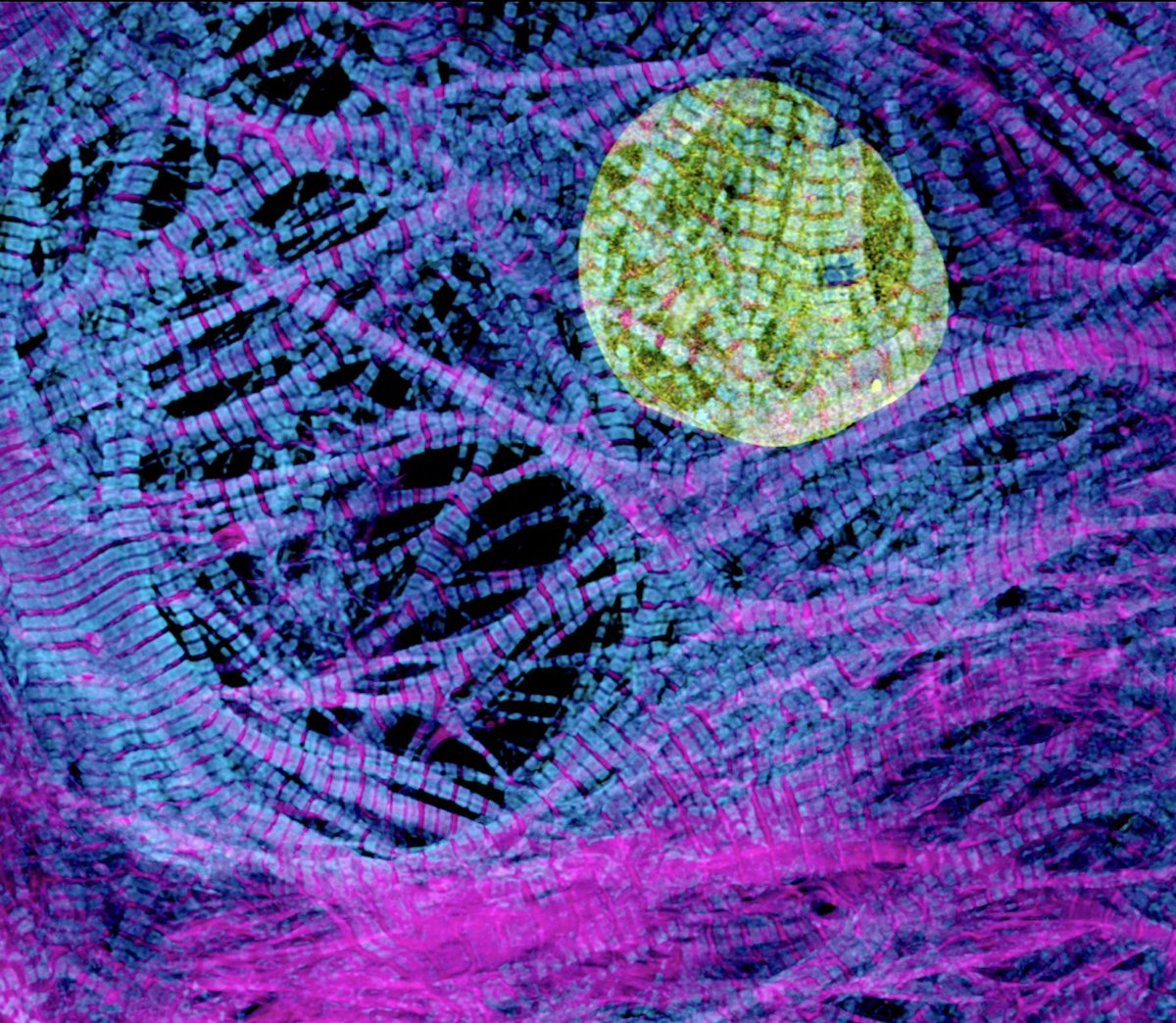 MAG2ART's tweet image. An iPSC cardiac myocyte (heart muscle cell) photographed through a microscope. That yellow thing is the DNA in the nucleus. The cyan things are the motor domains of myosin II, the molecular motor that drives muscle contraction. #CellBiology