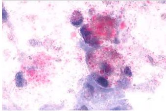 Biopolymers and acute respiratory distress syndrome associated with administration of biopolymers, a path to perfection or death: A Case report 

journalmechanicalventilation.com/2025-september…
